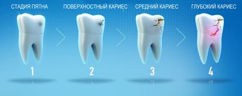 Стадії карієсу
