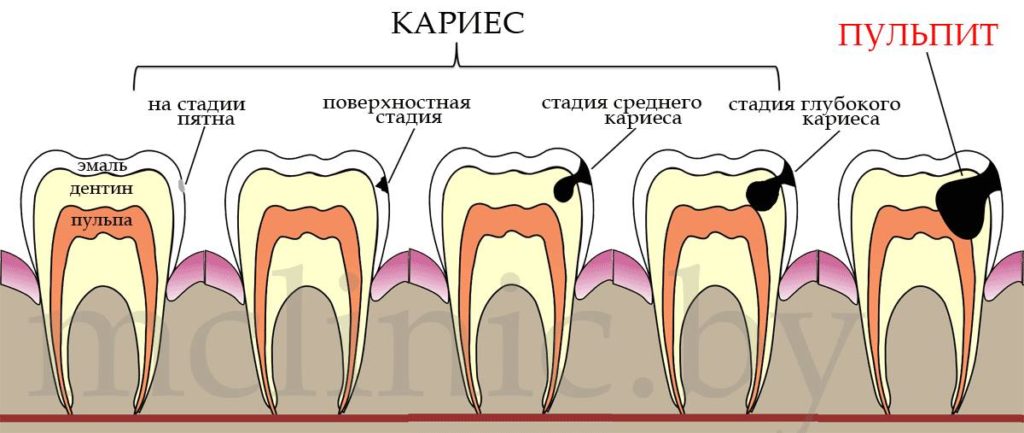 Ускладнення карієсу