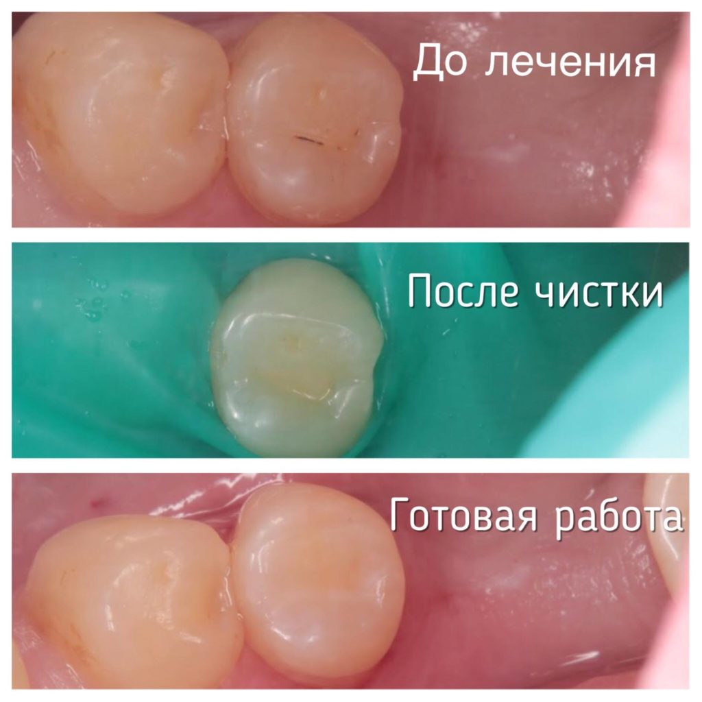 Що таке герметизація фісур?