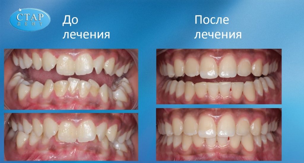 Ортодонтичне лікування